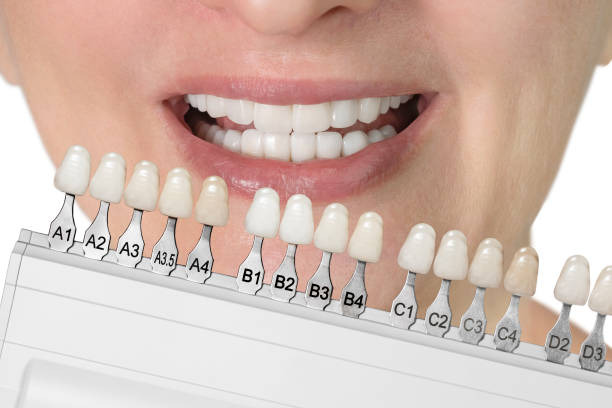 Front Teeth Crowns Vs Veneers Front Teeth Crowns Vs Veneers