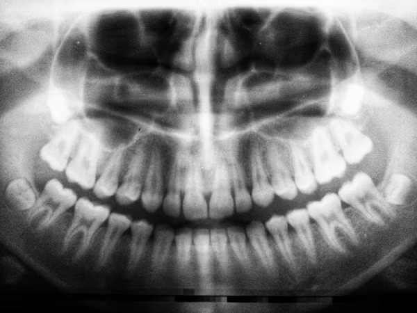 x-ray of a person's jaw showing the teeth alignment